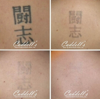 before after image of laser tattoo removal