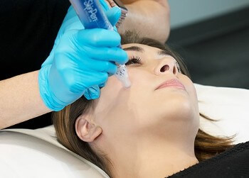Microneedling Pic