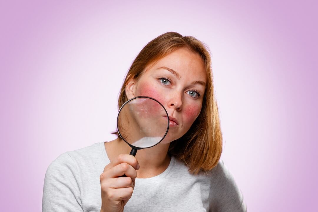 Treatment for Rosacea