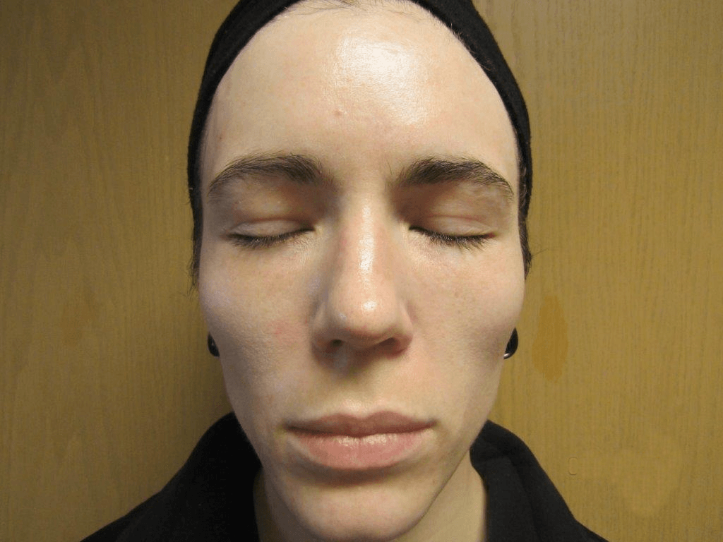 After Acne Treatments