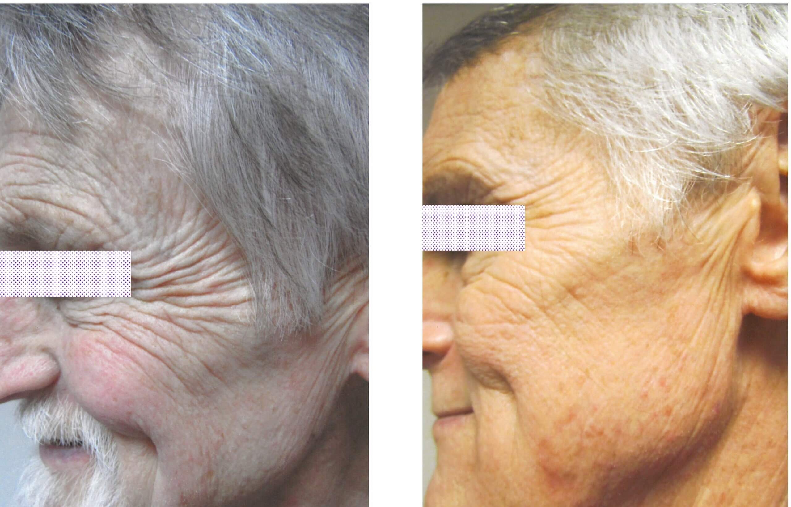 Before and After Fractional C02 Treatment