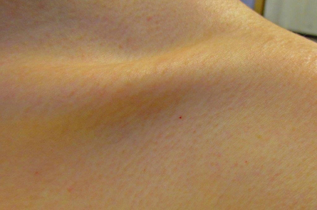 Tattoo Removal Treatments in the Pacific NW since 2002