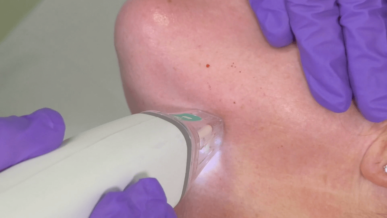 Treatment for Aging and Blemish Scar