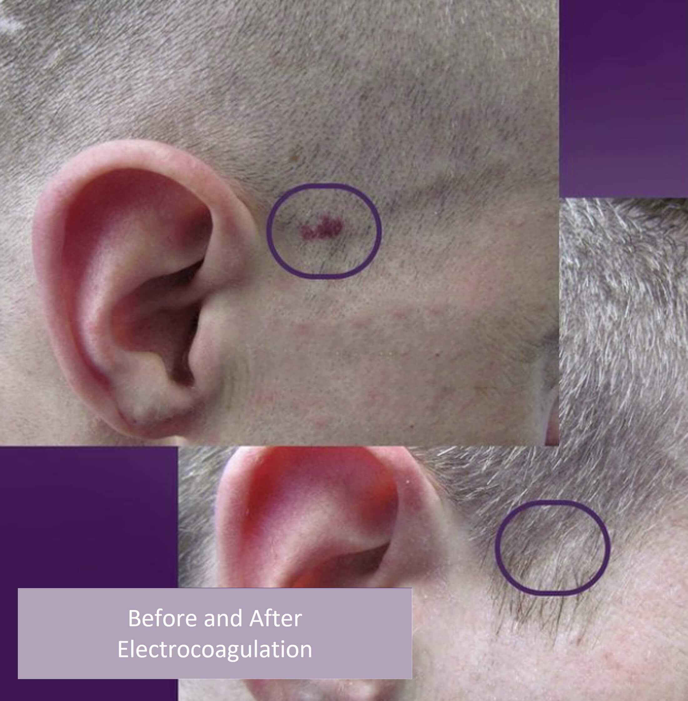 Broken Capillaries Treatment