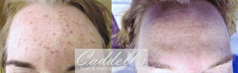 IPL/Photofacials