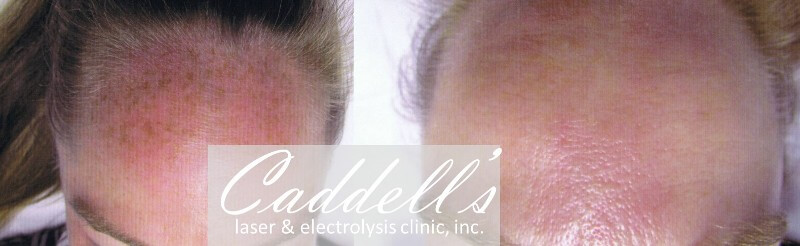  IPL / Photofacial Before After Combo