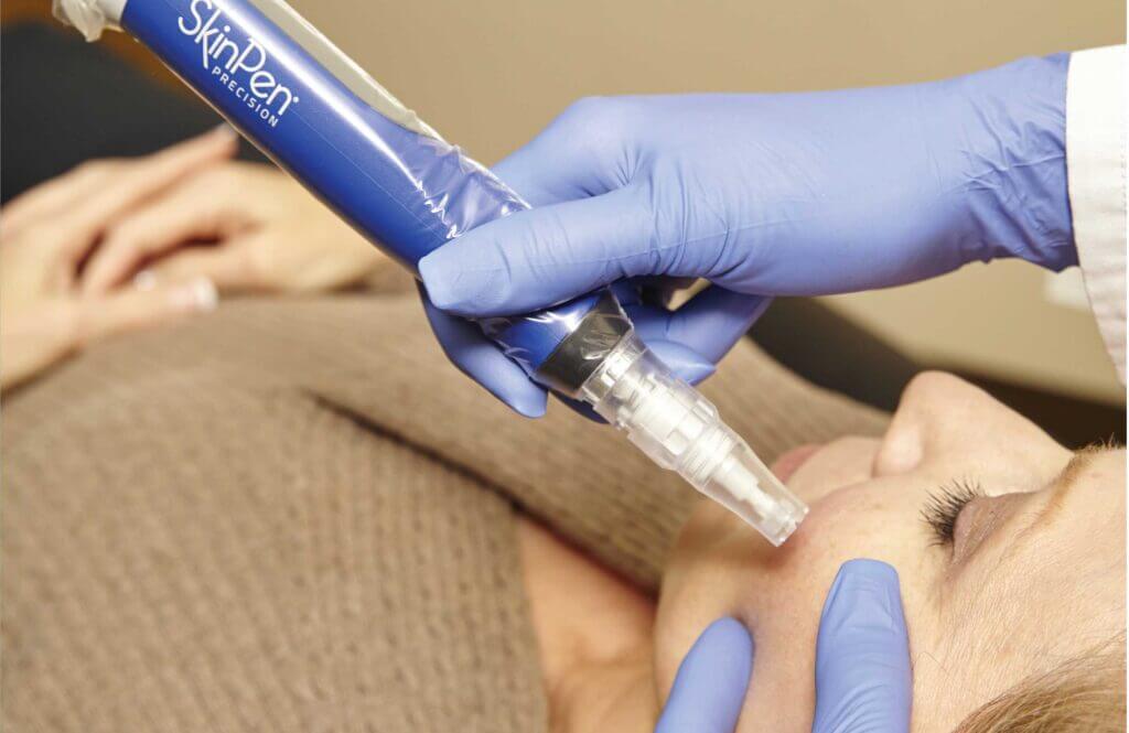 Natural Collagen Boosting with the SkinPen Microneedling Device